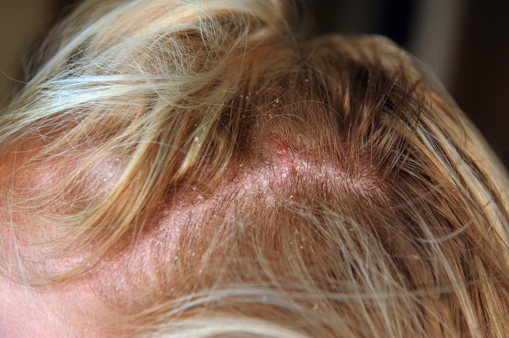 What Causes Scab Scalp After Bleaching